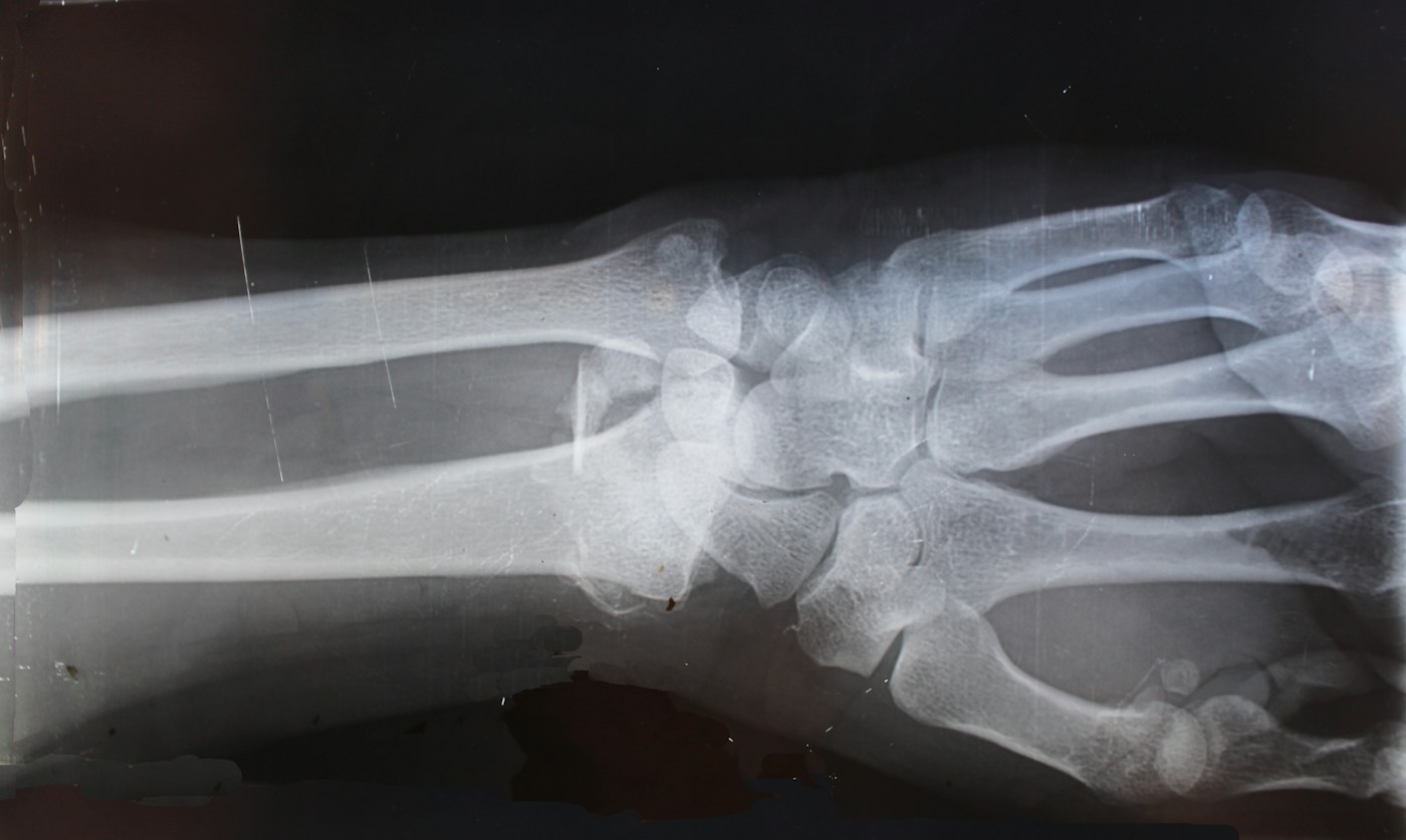 Cliché radiographique. Photographie d’illustration de l’imagerie articulaire, sans diagnostic d’arthrose attribué.