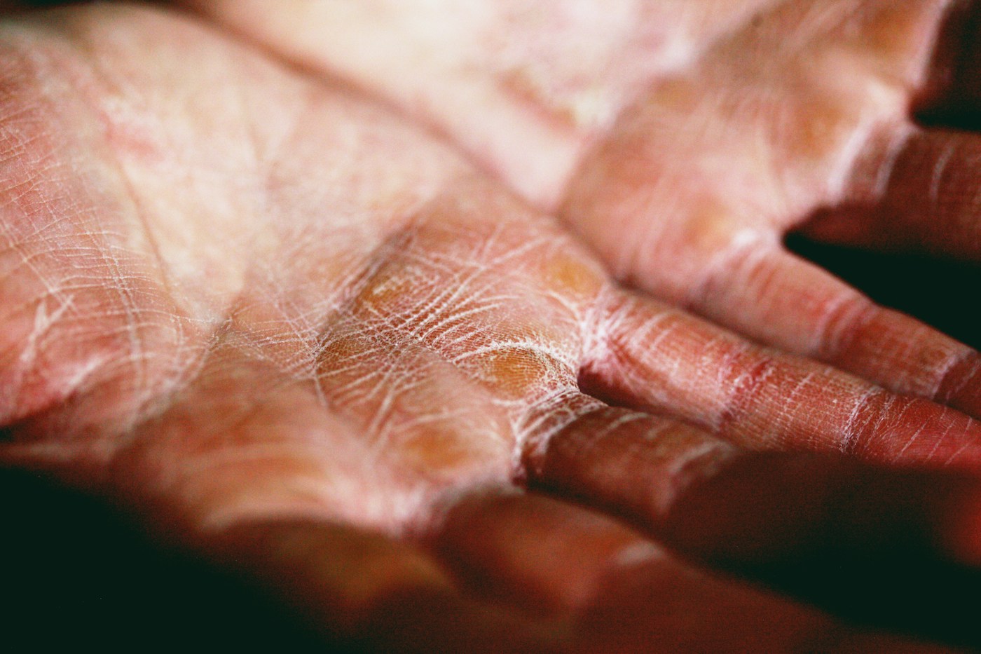 Paume de la main et peau sèche en gros plan. Photographie d’illustration, sans diagnostic d’eczéma attribué.