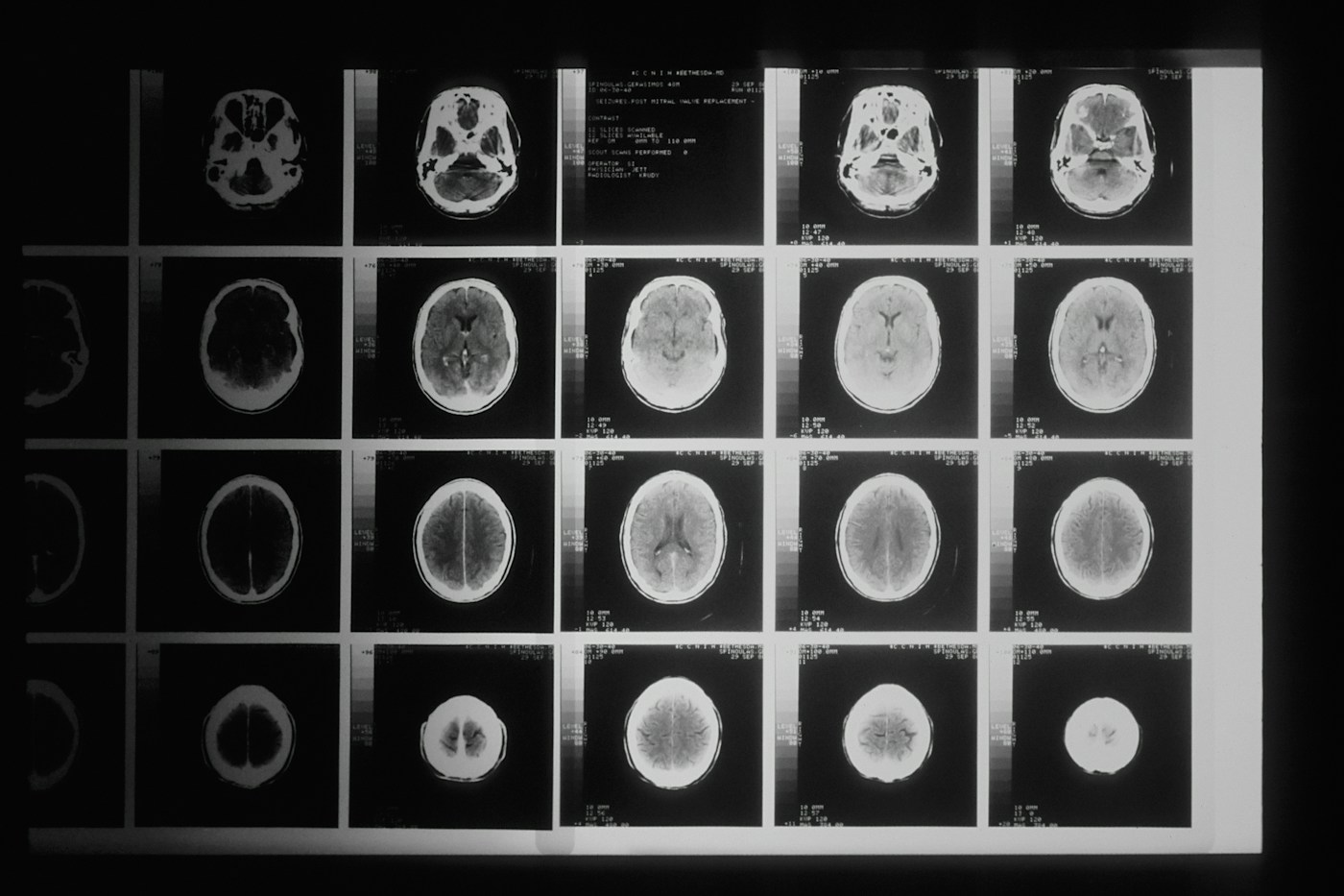 Série d’images médicales présentée en noir et blanc. Illustration documentaire, sans lésion ni migraine attribuée au cliché.