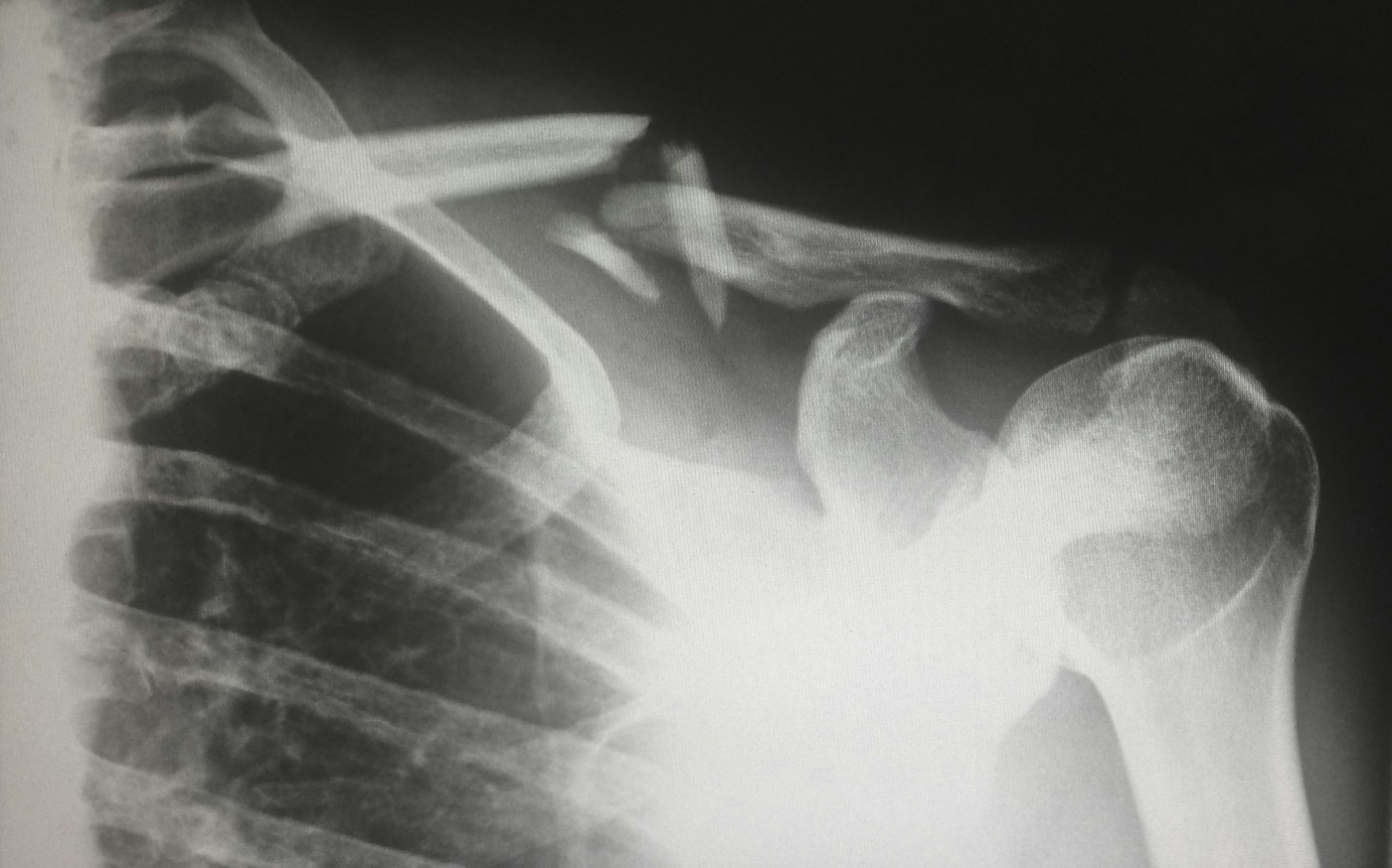 Cliché radiographique. Photographie d’illustration de l’imagerie osseuse, sans diagnostic d’ostéoporose attribué.